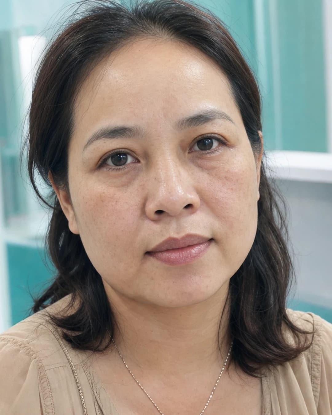Phụ nữ TP.HCM khoảng 42 tuổi với tình trạng sạm nhẹ và da không đều màu tại phòng khám Avo Medical.